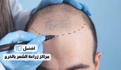 أفضل 10 مراكز زراعة الشعر بالخرج