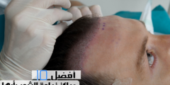 أفضل 10 مراكز زراعة الشعر بأبها