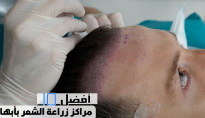 أفضل 10 مراكز زراعة الشعر بأبها