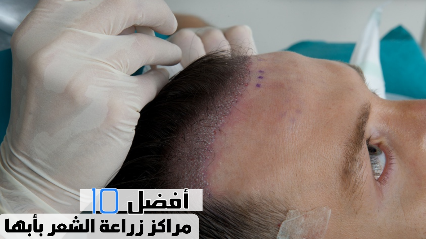 أفضل 10 مراكز زراعة الشعر بأبها