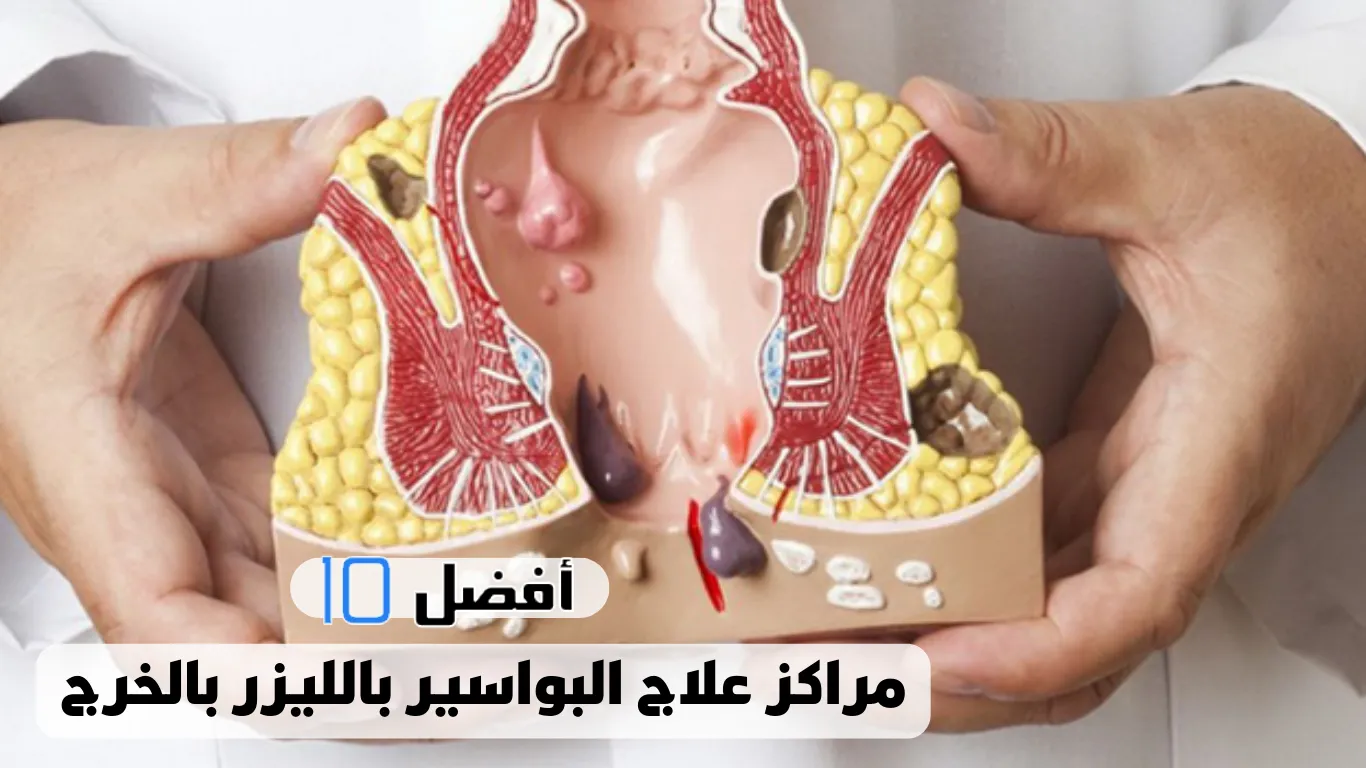 أفضل 10 مراكز علاج البواسير بالليزر بالخرج